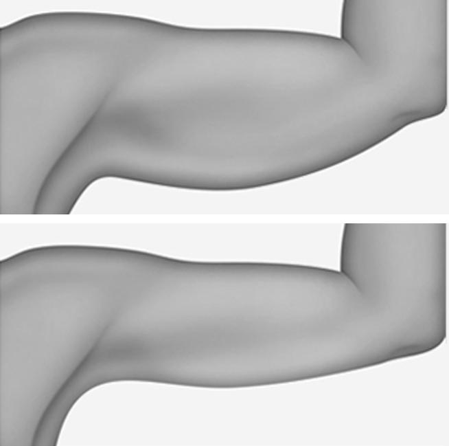 Flacidez nos braços: Lifting ou Cirurgia? - Guia Saúde Cidades