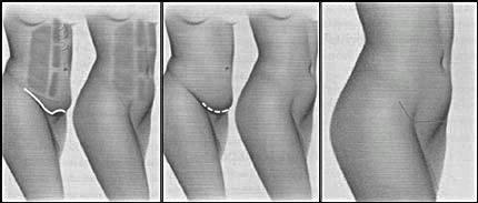 MINI-ABDOMINOPLASTIA