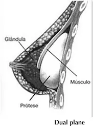 MASTOPEXIA COM PROTESES